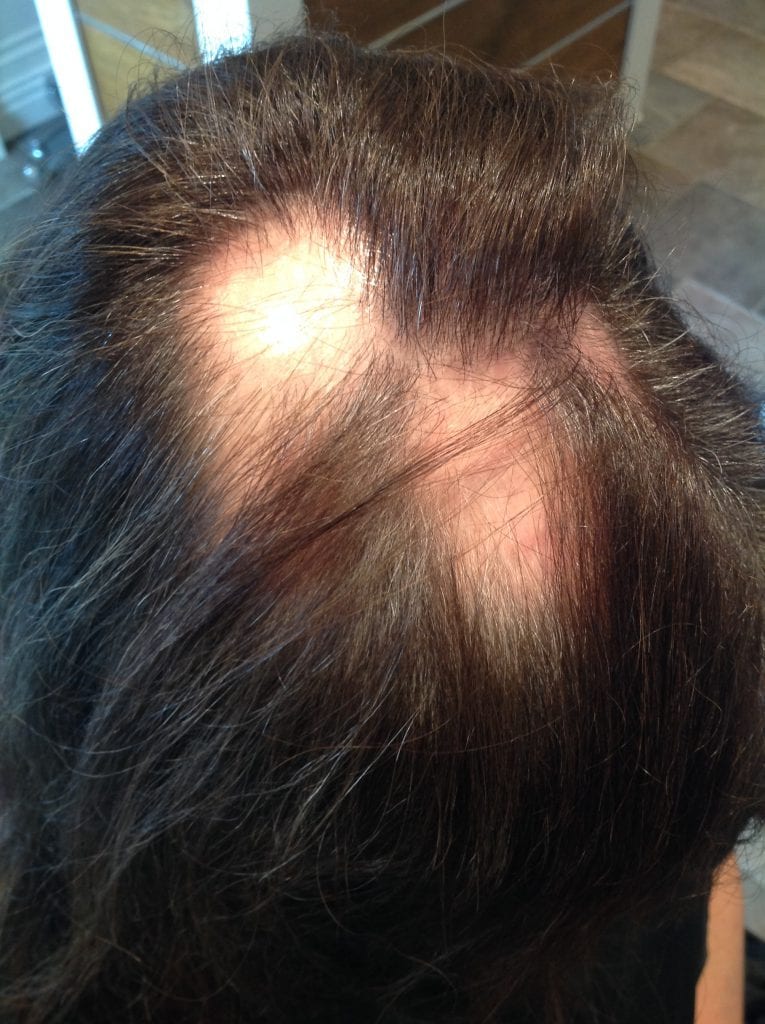Alopecia Hair Loss